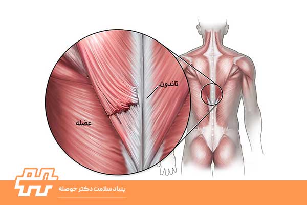 انواع رباط‌های کمر