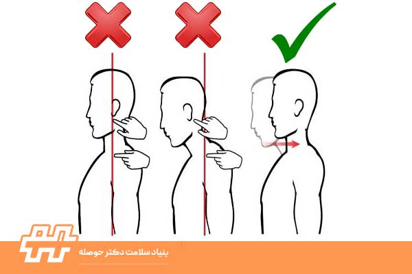 عارضه گردن صاف