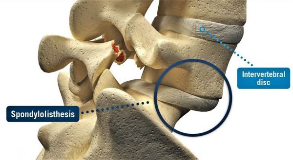 تشخیص اسپوندیلولیستزیس چگونه انجام می‌شود