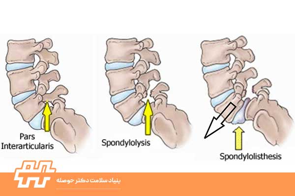 درمان اسپوندیلولیستزیس کمر