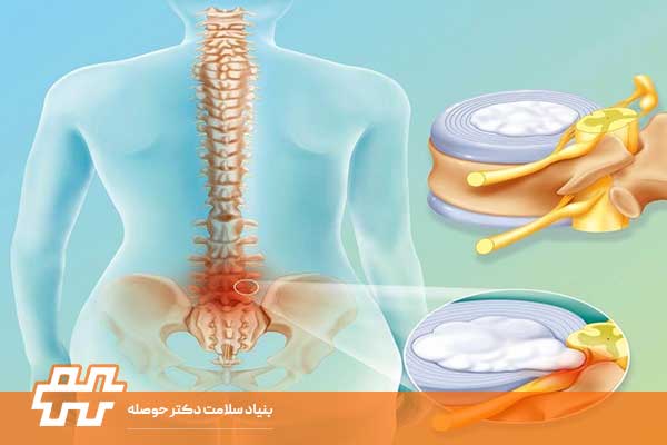 چرا مهره های کمر صدا میدهد