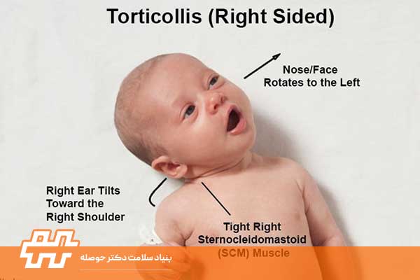 عارضه کج گردنی