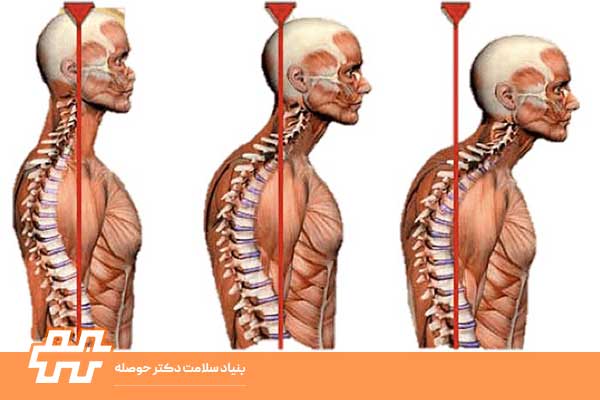 عارضه گردن صاف