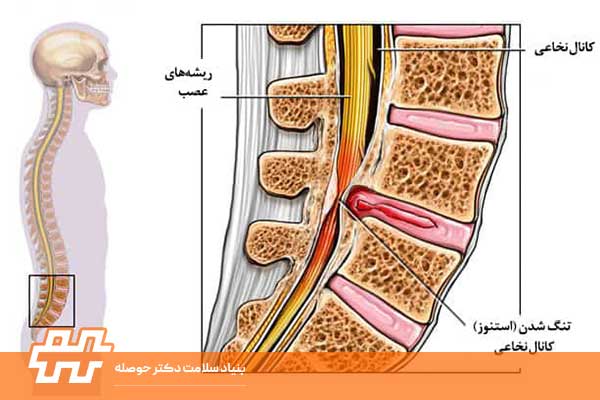 درمان تنگی کانال نخاعی بدون جراحی