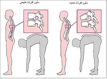 انواع عارضه قوز کمر