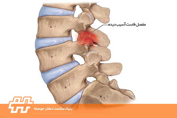 سندرم مفصل فاست ستون فقرات چیست و چگونه درمان می شود؟