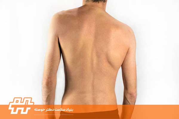 معرفی عارضه شانه نا برابر(Uneven Shoulders)