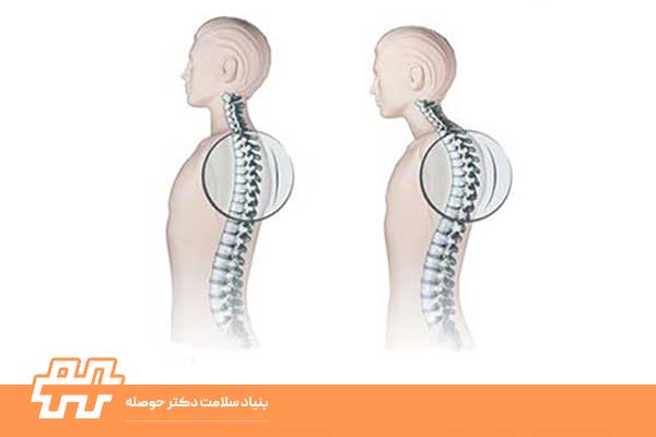 معرفی عارضه قوز کمر (Kyphosis)