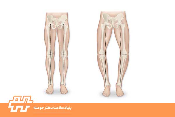 زانو پرانتزی