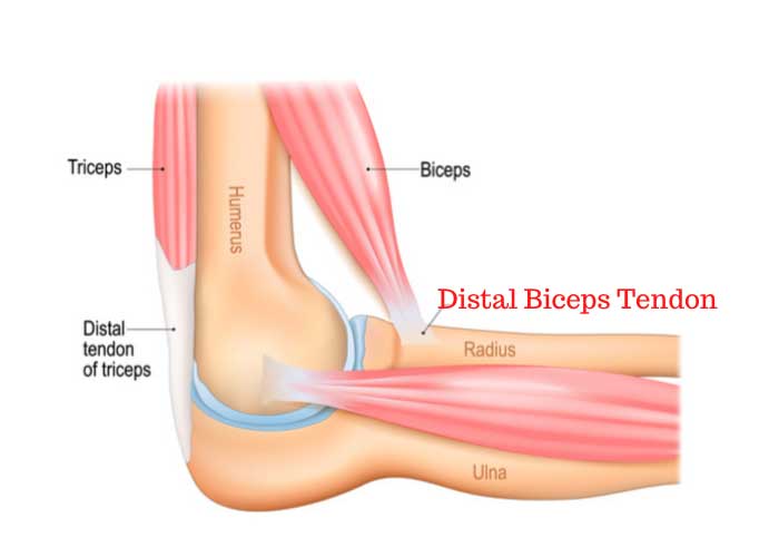 آسیب التهاب تاندون دوسر بازویی (Biceps Tendinitis)