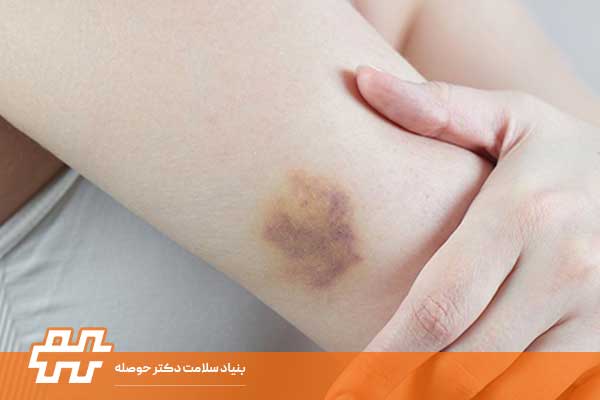 هماتوم بازو (Arm Hematoma)