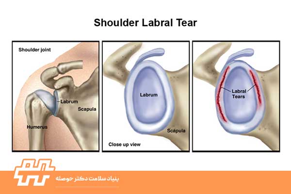 پارگی لابروم (Labral Tear)