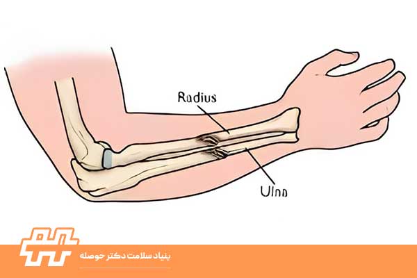 Radius and Ulna Fracture