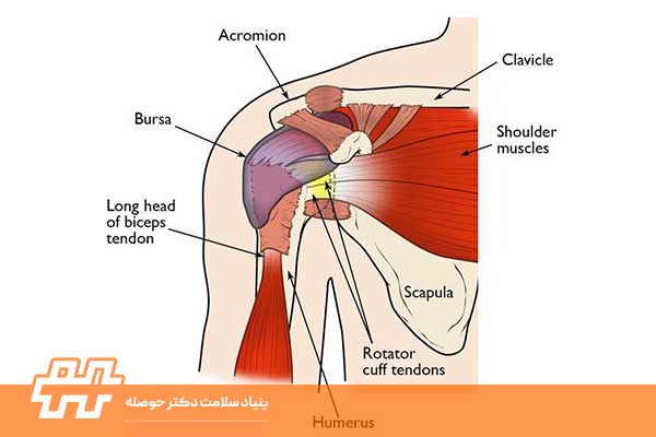 التهاب تاندون روتاتور کاف (Rotator Cuff Tendinitis)