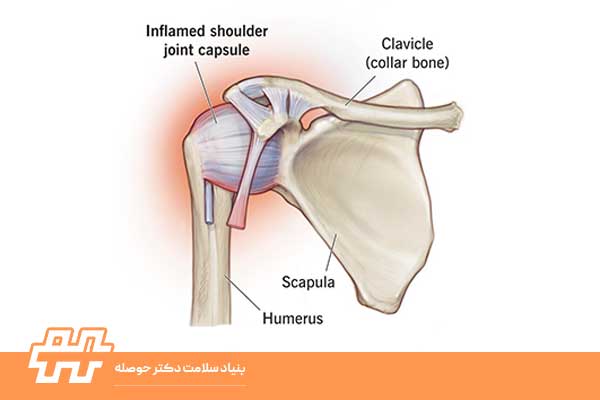  بررسی پارگی کپسول مفصل شانه و علائم آن
