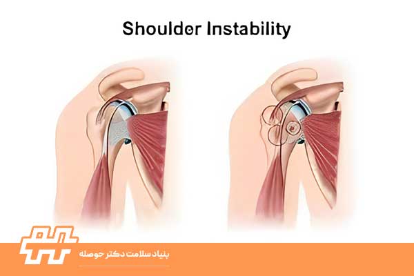 شانه ناپایدار