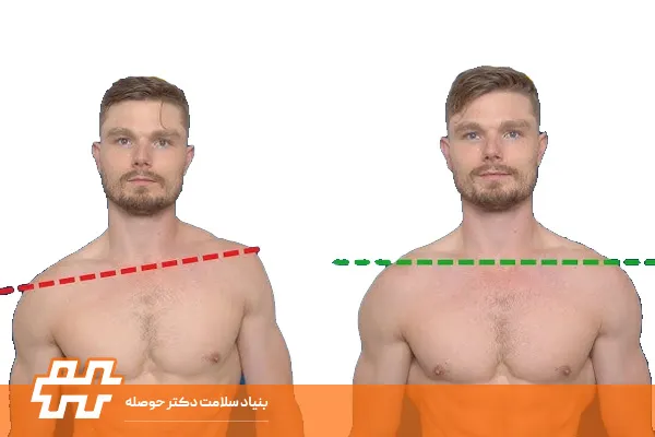 درمان شانه نابرابر با حرکات اصلاحی