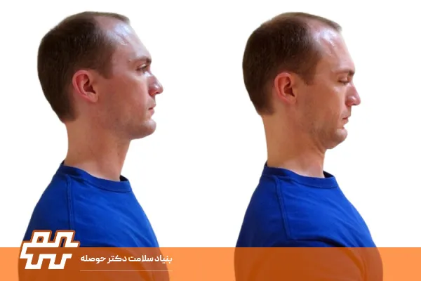 علت صاف شدن قوس گردن