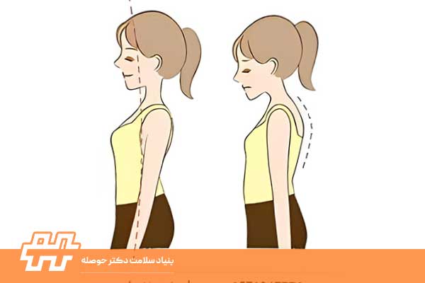 اصلاح شانه‌های افتاده