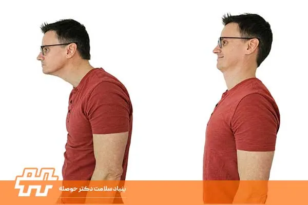 گردن رو به جلو