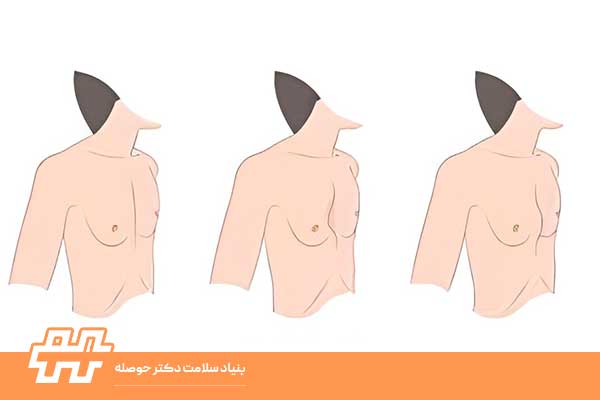 مقایسه سینه کبوتری و سینه قیفی