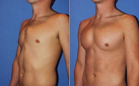  علائم سینه کبوتری در کودکان