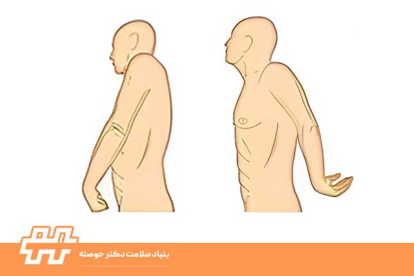 اختلال چرخش شانه