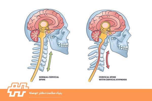 گردن صاف و قوس طبیعی گردن