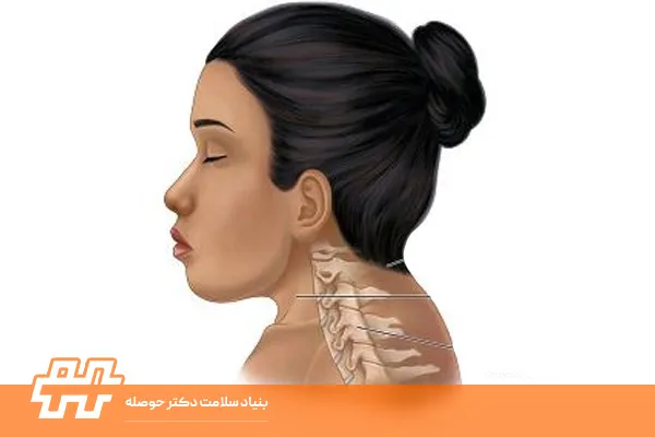 کوتاهی گردن در کودکان و بزرگسالان