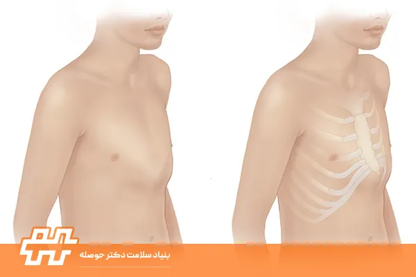 علائم سینه کبوتری