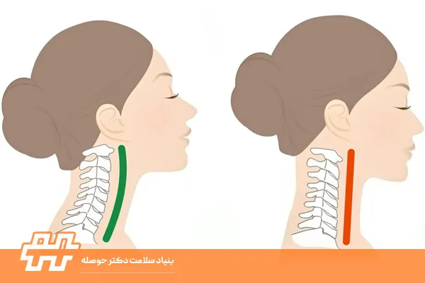 گردن صاف و دیسک گردن