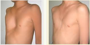 مقایسه سینه کبوتری و سینه قیفی