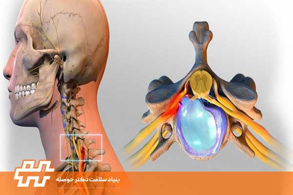 تشخیص عارضه گردن رو به جلو