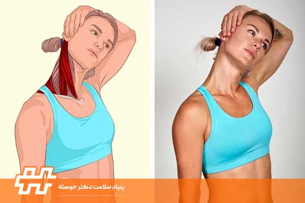 درمان کج گردنی