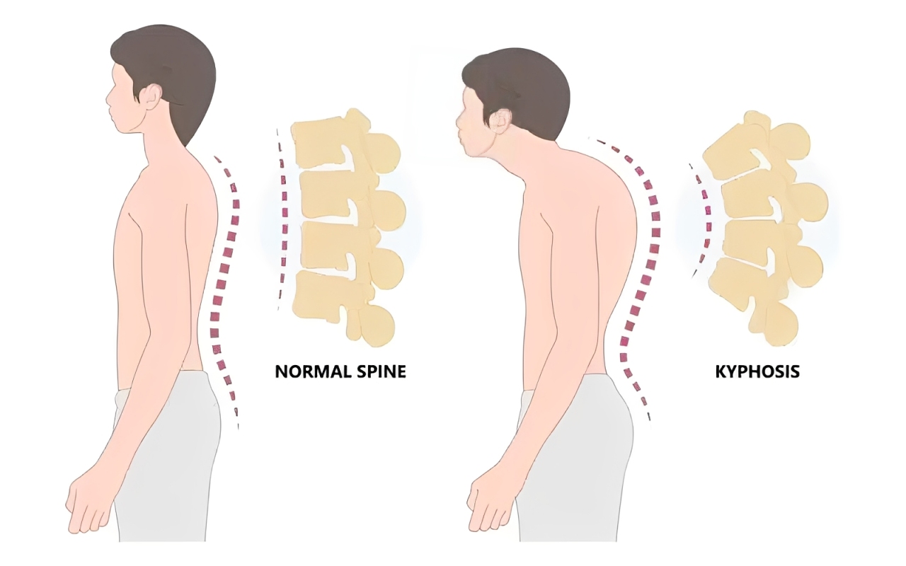 کایفوزیس شانه‌