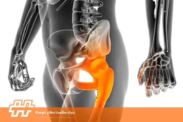 افتادگی لگن