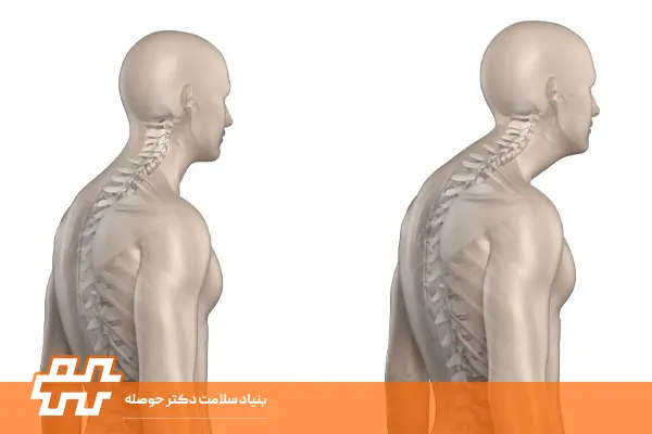 کیفوز شانه‌