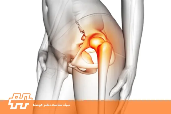 علائم افتادگی لگن