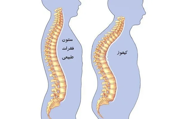 قوز کمر