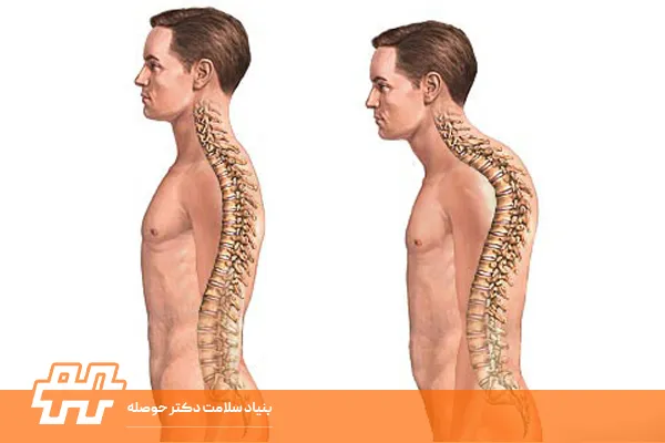 پیشگیری از قوز کمر