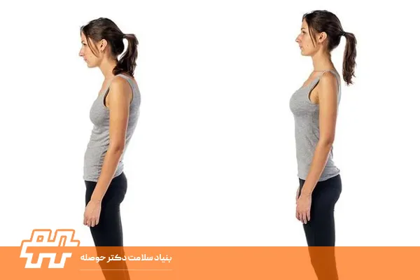 قوز کمر یا گوژ پشتی