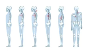 درمان اسکولیوز بدون جراحی