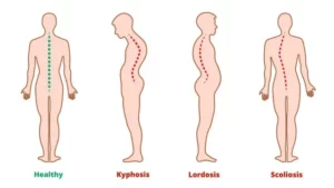 تست‌های خانگی برای تشخیص Flat Back یا  Lordosis