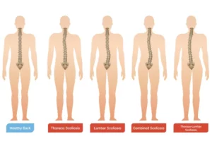 چه تفاوتی بین اسکولیوز ۳۰ درجه و انحرافات خفیف وجود دارد؟