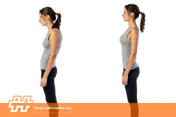 چطور زندگی روزمره با کیفوز را بهتر مدیریت کنیم؟