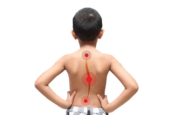 اسکولیوز در کودکان