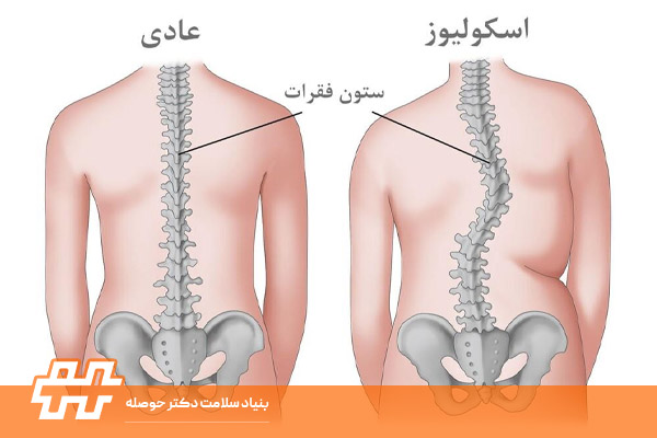 انواع اسکولیوز
