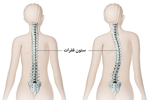 انواع اسکولیوز