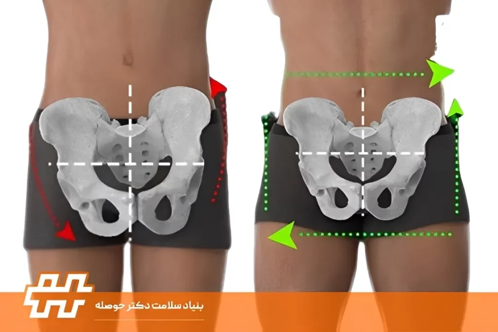 اصلاح انحراف جانبی لگن