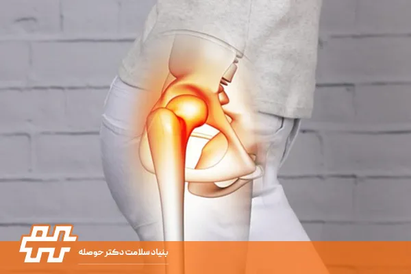 انحراف جانبی لگن